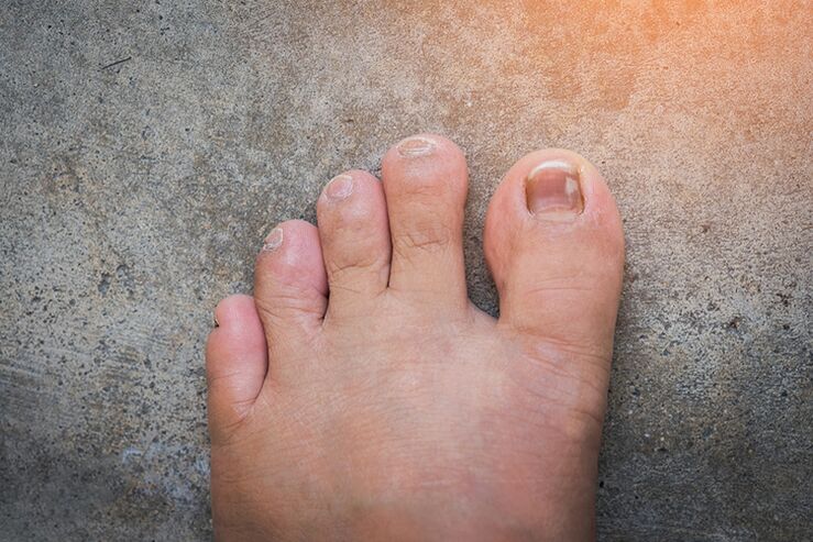 Nagelpilz