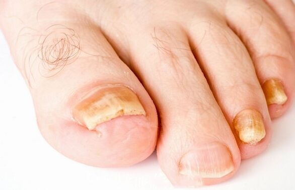 Nagelpilzformen