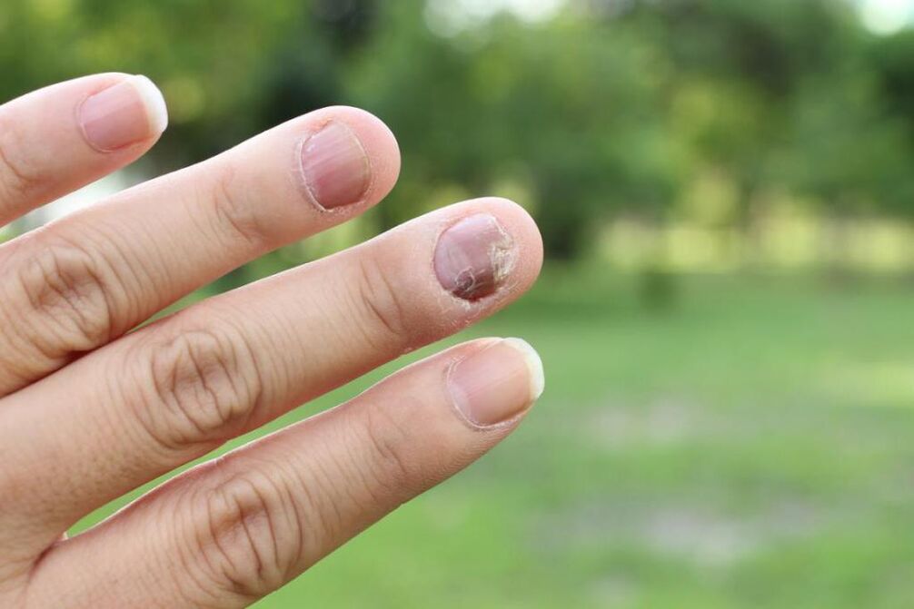 Nagelpilz