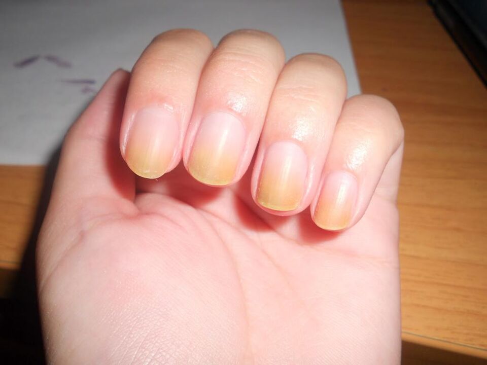 Symptome von Nagelpilz