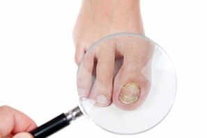 Nagelpilz